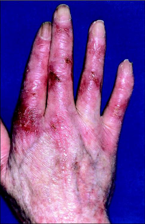 Figure 1 Cutaneous ulcerations, erythema and skin atrophy of the right hand 