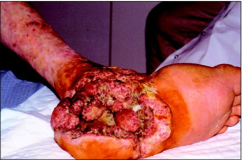 morpheaform basal carcinoma morphea