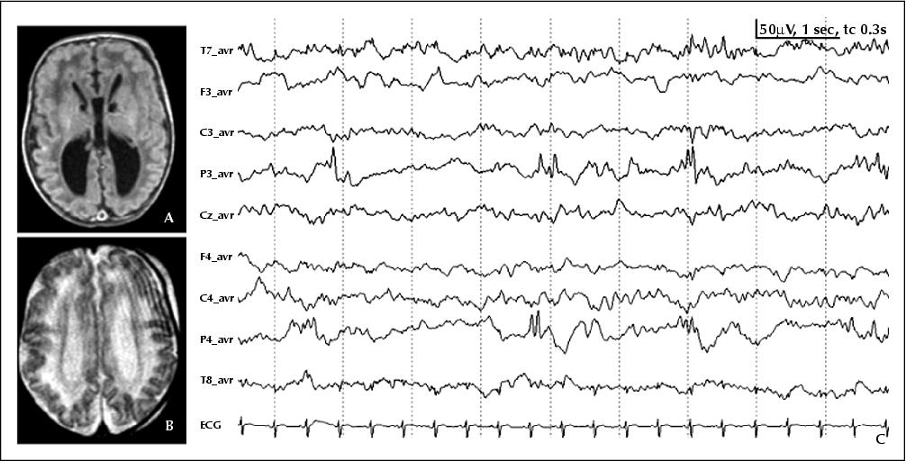 Figure 5 A) T1w and B) T2w MRI of an infant with Zellweger syndrome Figure 5 A) T1w and B) T2w MRI of an infant with Zellweger syndrome