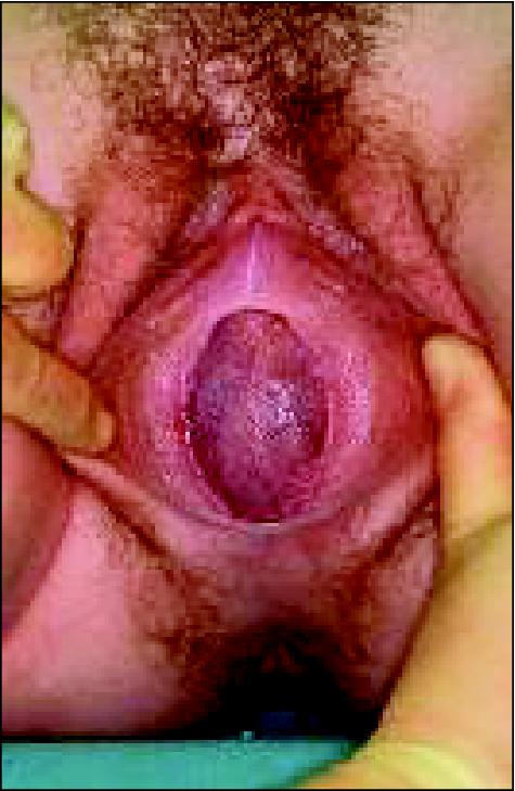 Imperforate hymen with domeshaped purplishred hymeneal membrane