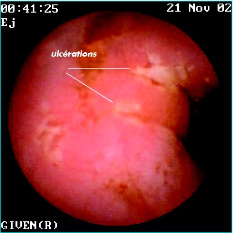 cas de maladie de Crohn.