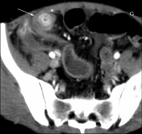 Figure 9 Maladie de Crohn avec