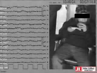 Eating epilepsy. Heterogeneity of ictal semiology: the role of video-EEG monitoring