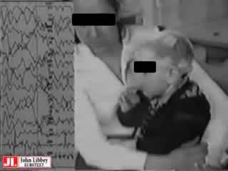 Clinical and EEG video-plygraphic features of emileptic spasms in a child with dihydropteridine deductase deficiency. Efficiency fo hydrocortisone