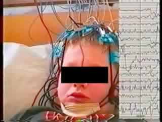 Epileptic nystagmus: electroclinical study of a case