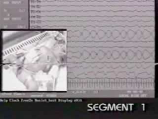 Neonatal seizures: background EEG activity and the electroclinical correlation in full term neonates with hypoxic-ischemic encephalopathy.