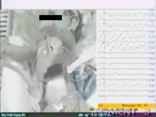 Neonatal seizures: background EEG activity and the electroclinical correlation in full term neonates with hypoxic-ischemic encephalopathy.