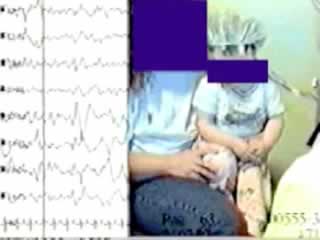Epileptic spasms in clusters without hypsarrhythmia in infancy