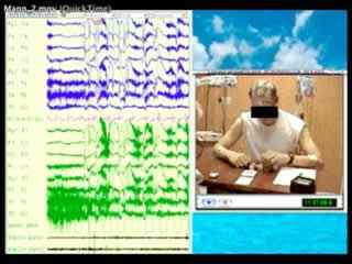 Chess-playing epilepsy: a case report with video-EEG and back averaging