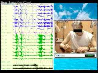 Chess-playing epilepsy: a case report with video-EEG and back averaging