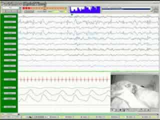 Ictal video-polysomnography and EEG spectral analysis in a child with severe Panayiotopoulos syndrome