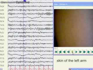 Pilomotor seizures associated with sequential changes in magnetic resonance imaging