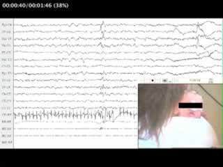 Focal motor seizure with automatisms in a newborn