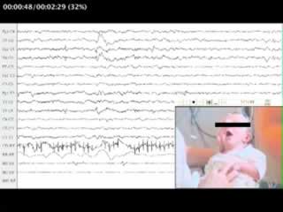 Focal motor seizure with automatisms in a newborn