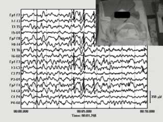 Refractory and lethal status epilepticus in a patient with ring chromosome 20 syndrome