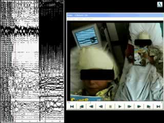 MRI-negative prefrontal epilepsy due to cortical dysplasia explored by SEEG