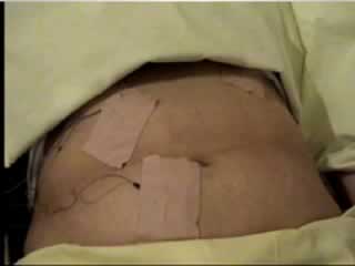 A patient with two episodes of epilepsia partialis continua of the abdominal muscles caused by cortical dysplasia