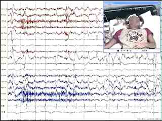 Convulsive syncope: a condition to be differentiated from epilepsy