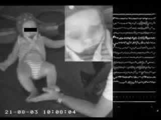 Shaking body attacks: a new type of benign non-epileptic attack in infancy