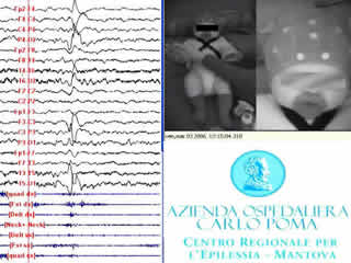 Shaking body attacks: a new type of benign non-epileptic attack in infancy