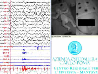Shaking body attacks: a new type of benign non-epileptic attack in infancy