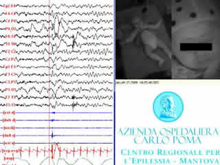 Shaking body attacks: a new type of benign non-epileptic attack in infancy