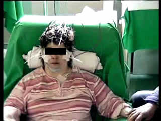 Epilepsy in adult patients with Down syndrome: a clinical-video EEG study