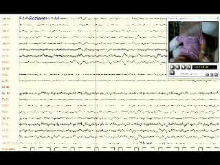 Involuntary movements after correction of vitamin B12 deficiency: a video-case report