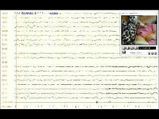 Involuntary movements after correction of vitamin B12 deficiency: a video-case report