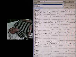 Adversive seizures associated with periodic lateralised epileptiform discharges (PLEDs) after left orbital contusion