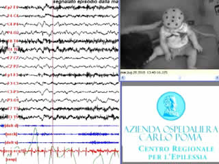 Head atonic attacks: a new type of benign non-epileptic attack in infancy strongly mimicking epilepsy