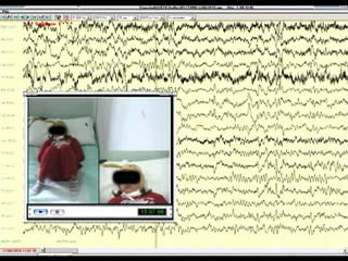 Pure epileptic headache and related manifestations: a video-EEG report and discussion of terminology