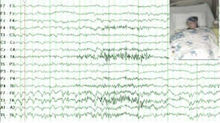 Post-traumatic epilepsy with isolated memory flashbacks