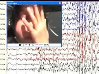 Self-induction seizures in sunflower epilepsy: a video-EEG report
