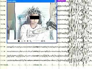 Self-induction seizures in sunflower epilepsy: a video-EEG report