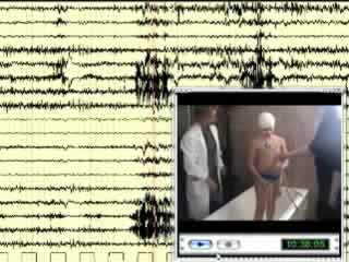 Hot water epilepsy: a video case of a European boy with positive family history and subsequent non-reflex epilepsy