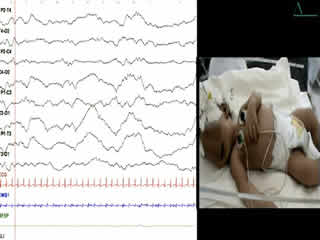 Neonatal hyperekplexia with homozygous p.R392H mutation in GLRA1