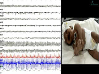 Neonatal hyperekplexia with homozygous p.R392H mutation in GLRA1