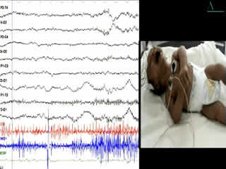 Neonatal hyperekplexia with homozygous p.R392H mutation in GLRA1