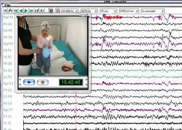 Non-epileptic myoclonic attacks in infancy: three cases