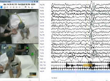 Non-epileptic myoclonic attacks in infancy: three cases