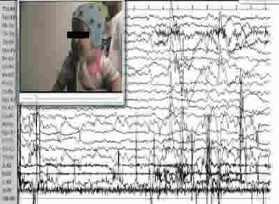 Non-epileptic myoclonic attacks in infancy: three cases