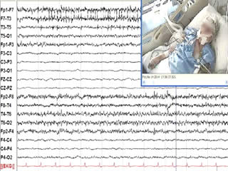 Periodic eye opening and upward eye deviation accompanied by burst-suppression, as an isolated clinical manifestation of acute post-hypoxic myoclonus