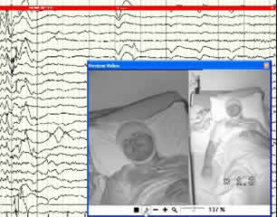 Successful epilepsy surgery in frontal lobe epilepsy with startle seizures: a SEEG study