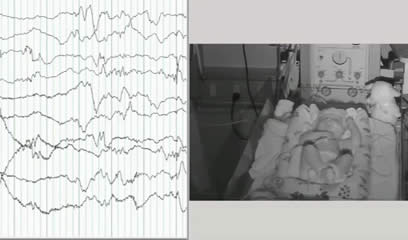 Pointed rhythmic theta waves: a unique EEG pattern in KCNQ2-related neonatal epileptic encephalopathy