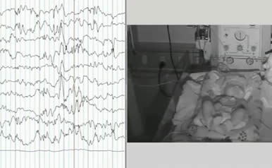 Pointed rhythmic theta waves: a unique EEG pattern in KCNQ2-related neonatal epileptic encephalopathy