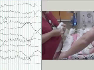 Pointed rhythmic theta waves: a unique EEG pattern in KCNQ2-related neonatal epileptic encephalopathy