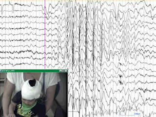 Pharmacoresistant epileptic eyelid twitching in a child with a mutation in SYNGAP1