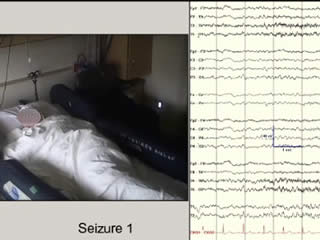 Seizure semiology of anti-LGI1 antibody encephalitis