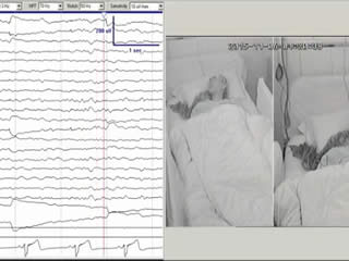 Sleep-related hypermotor epilepsy activated by rapid eye movement sleep